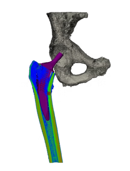 Implant design and population based fit studies to inform engineering